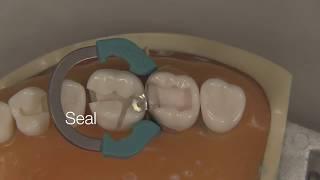 Class II Composite Restoration | Stevenson Dental Solutions