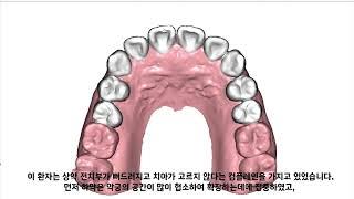 D1 Dental 디원치과 아미절라인 투명교정 윤*경 님 케이스리포트