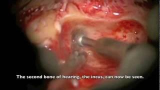 Right Cochlear Implant (Bionic Ear) Surgery - Dr Nirmal Patel, Sydney Australia