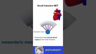 Elective Surgery for Small Intestine Neuroendocrine Tumors: Mesenteric Ischemia