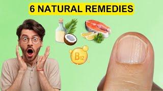 Discover 6 natural remedies with us to combat vertical nail ridges and rejuvenate nail health