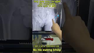 Thay khớp háng cho người gãy xương háng || Chân ngắn 10 phân