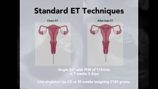 Live birth after transmyometrial embryo transfer in a patient with radical trachelectomy