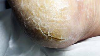 Thick Calluses With Cracks In The Center, Need Trimming!【Pedicure Master Lin Jun】