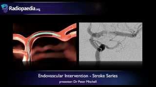 Stroke: Endovascular management of ischaemic stroke - radiology video tutorial