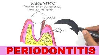 Periodontal Disease | Pathogenesis