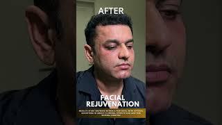 Facial Rejuvenation to Restore Youthfulness By Dr Adarsh Tripathi #skincare