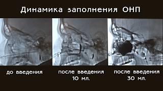 Гайморит.  Введение лекарственного препарата в пазухи при лечении гайморита. ЯМИК -процедура.