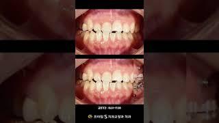 30대 치아교정, 1년 7개월 변화 과정 #치아교정 #교정전후 #교정과정 #교정전문의 #교정전문치과 #쇼츠