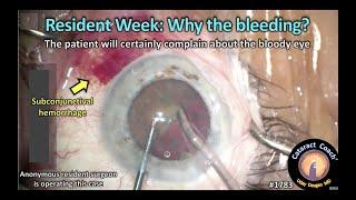 CataractCoach™1783: resident week: why the bleeding?