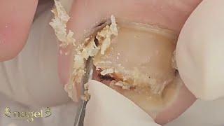 VEJA TUDO O QUE SAIU DALI DEPOIS DO PEELING QUÍMICO #satisfying #nails