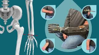 Intro to Amputations of the Upper Limb