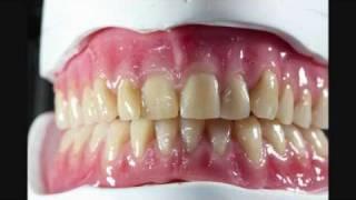 Elite Dental Studios Gerber denture setup for Candulor competition