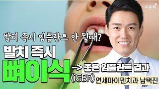 발치 즉시 임플란트 안 될때? 발치 즉시 뼈이식(iGBR) → 좋은 임플란트 결과 / 연세마이덴치과 남택진