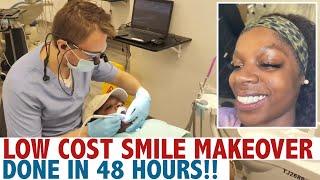 Low Cost Smile Makeover in Miami Done in 48 Hours!!