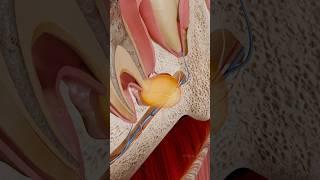 Periapical pocket cyst 3D visualization: a hidden threat to your oral health