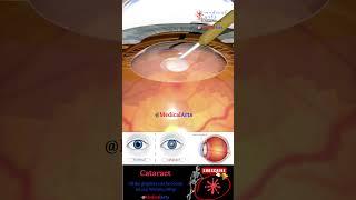 Cataract - Lens Implant - Medical Arts Shorts - 3d animation surgery