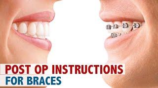 Post Op Instructions For Braces