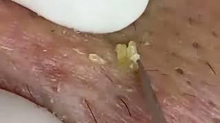 حب الشباب الرؤوس السوداء #Blackheads #acne #pimple