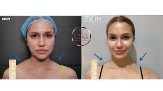 Barbie TrapTox Plus Barbie skin with Eladerm | Dr. Contessa Salvador MD