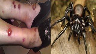 Spider bite look like | Deadliest spiders in the world #spider #venom2