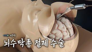 [명의 의학백과] 뇌수막종 절제 수술
