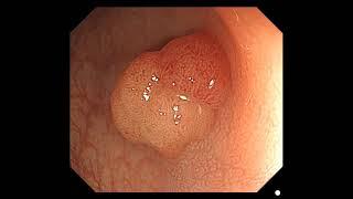 JNET classification (E-leraning video)