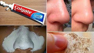 In Just 5 Mints Best Way to Remove BLACKHEADS With Toothpaste/ Toothpaste for Remove BLACKHEADS