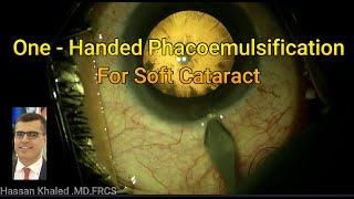 One - Handed phacoemulsification for Soft Cataract