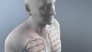 HOW IS EPITHELIOID PERITONEAL MESOTHELIOMA DIAGNOSED?