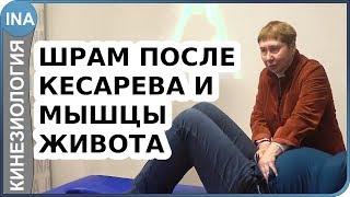 Влияние шрама от кесарево на мышцы живота. Как убрать живот? Васильева кинезиоология