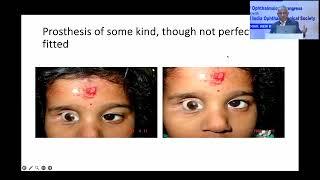 AIOS2025 IC438 T Dr Ashok Kumar GROVER Socket Reconstruction  Management Principles