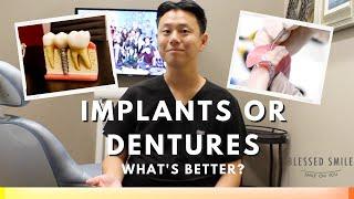 DENTAL IMPLANT vs. DENTURE to Replace Missing Teeth | Dentist Reviews