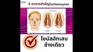 4 อาการสำคัญของโรคโพรงจมูกคด