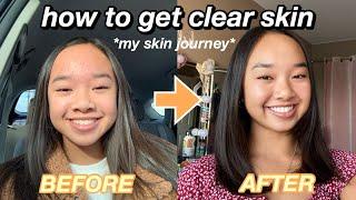 HOW TO GET CLEAR SKIN *my skin journey* | Nicole Laeno