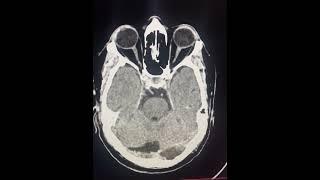 SUBACUTE INFARCT IN LEFT PCA. #radiology #neurology #ctscan