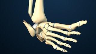 Ankle Fracture Surgery