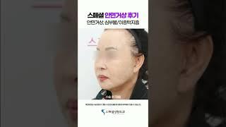 안양 / 60대 안면거상 / 심부볼지방흡입 / 이중턱지방흡입 / 1개월차 BEFORE & AFTER ￼