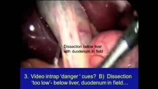 Video Symposium:  Fear During the Routine Lap Chole - The Bile Duct Might Be/Is Injured