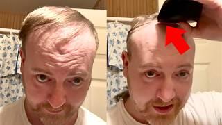 BALDING Man NERVOUSLY Shaves Head BALD IS SHOCKED  !