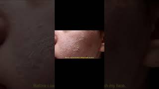 I used Revox Just Salyicid acid for 5 day-Results