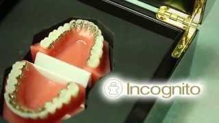 Incognito Behind the Teeth Braces | Pensacola Orthodontist