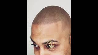 Scalp Micro Pigmentation | SMP Treatment In Pune | Natural Brows Academy