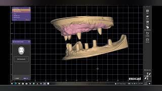 exocad full arch upper & lower implant with gingiva design Mr.Walid Mansour 00201005587414  Egypt