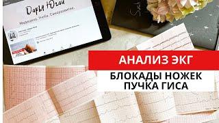 Блокада правой и левой ножек пучка Гиса. ЭКГ диагностика. Двухпучковая, трехпучковая блокады.