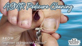 ASMR Pedicure Cleaning‍️Ingrown vs Impacted Toenail