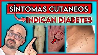 7 SEÑALES de la DIABETES que se manifiestan en la PIEL || ¡INDICAN una diabetes NO DETECTADA!