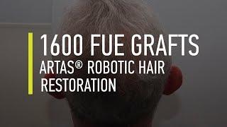 Hair transplant. ARTAS Robotic Hair Restoration in Hair By Dr. Max, Fort Lauderdale, Florida.