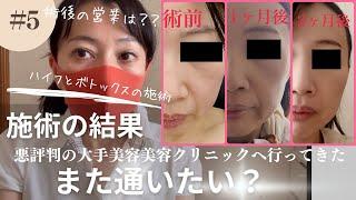 【5】悪い噂の美容クリニックへ行ってきた【難病独身アラフィフ】とても評判の悪い美容クリニックT●●へ行ってきました。数か月後の施術結果について。よかったのか？また行きたいのか？