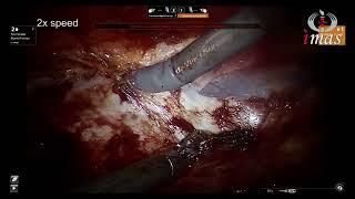 Robotic recurrent lateral incisional hernia (eTEP / RS / Right TAR) repair